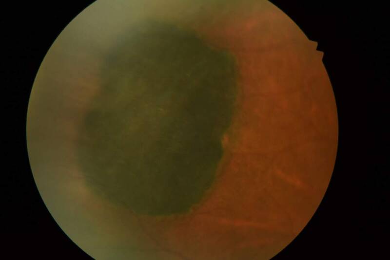 Congenital Hypertrophy of the Retinal Pigmented Epithelium (CHRPE)