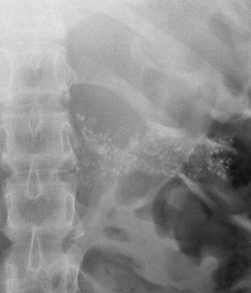 Figure 1. . X-ray abdomen showing multiple tiny opacities in epigastric region, suggestive of pancreatic calcification.