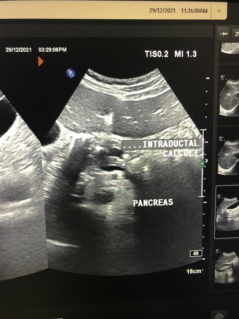 Figure 2. . Ultrasound of abdomen showing atrophic pancreas, with dilated main pancreatic duct and multiple calculi in main pancreatic duct.