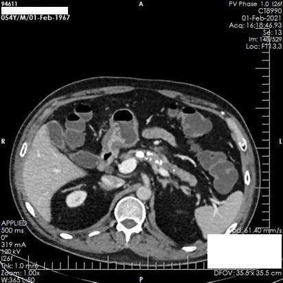 Figure 3. . CT scan of abdomen showing atrophic pancreas with few parenchymal foci of calcification.