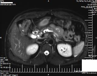 Figure 4. . MRI scan of abdomen (axial -T2 weight HASTE sequence) showing atrophic pancreas with dilated main pancreatic duct and few filling defects within, suggestive of calculi.