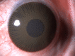 Digital image depicting a cosmetic contact lens in a patient with leucomatous corneal opacity Contributed by Dr