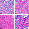 Most common phenotypic findings in BPDCN