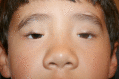 Male Child with Blepharophimosis Syndrome