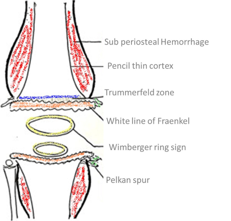 Figure 1. . Illustration of the radiological features of scurvy.