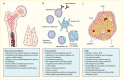 Three panel illustration. Left – cross section of bone marrow and thymus. Center – six different immune cell types and autoantibodies. Right – Beta cells and other cell types seen in a pancreas lobule.