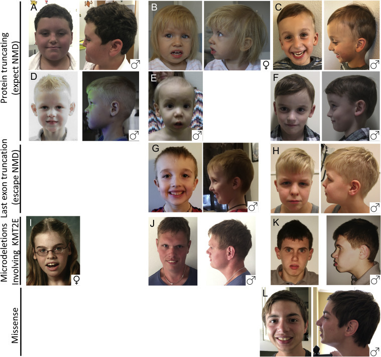 Figure 1. . Consistent facial features of individuals with KMT2E-related neurodevelopmental disorder include dolichocephaly, tall forehead, and deep-set eyes, often with downslanting palpebral fissures, periorbital fullness, prominent cheeks, and prominent nasolabial folds.