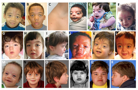 Figure 1. . Photographs of six affected individuals at different ages.