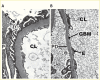 Picture showing local podocyte detachment in peripheral glomerular
capillaries in a Pima Indian with type 2 diabetes 