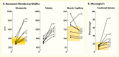 Line graphs showing widened glomerular and tubular basement membranes
and increased mesangial fraction in those with diabetes compared to an
identical twin without diabetes