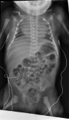 Figure 2. . An individual with chondrodysplasia with congenital joint dislocations, CHST3-related.