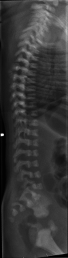 Figure 3. . An individual with chondrodysplasia with congenital joint dislocations, CHST3-related.