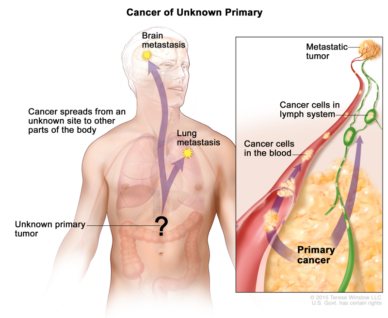 Cancer of unknown primary; drawing shows a primary tumor that has spread from an unknown site to other parts of the body (the lung and the brain). An inset shows cancer cells spreading from the primary cancer, through the blood and lymph systems, to another part of the body where a metastatic tumor has formed.