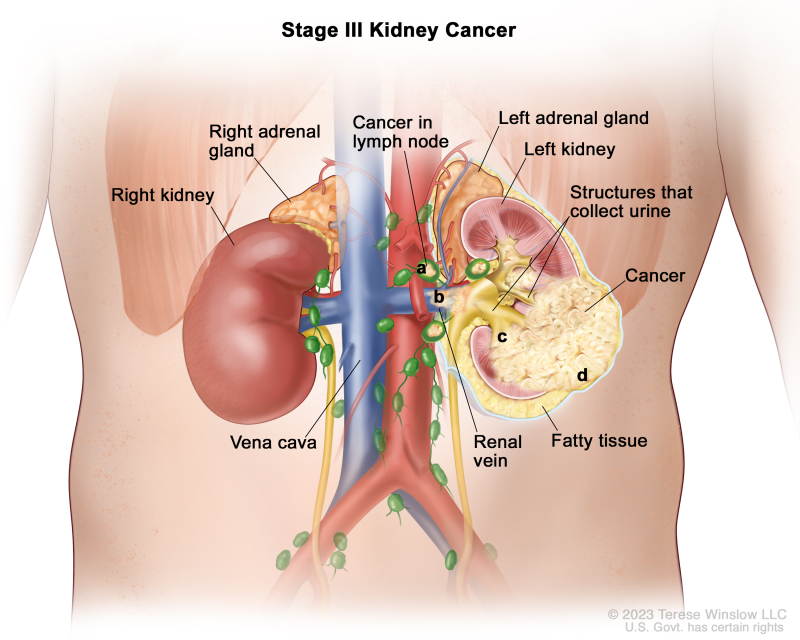 Stage III kidney cancer; drawing shows cancer in the left kidney and in a) nearby lymph nodes, b) the renal vein, c) the structures in the kidney that collect urine, and d) the layer of fatty tissue around the kidney. Also shown are the right kidney, the right and left adrenal glands, and the vena cava.