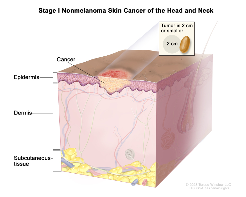 Stage I nonmelanoma skin cancer of the head and neck; drawing shows cancer in the epidermis (the outer layer of the skin). An inset shows that the tumor is 2 centimeters or smaller and that 2 centimeters is about the size of a peanut. Also shown are the dermis (the inner layer of the skin) and the subcutaneous tissue below the dermis.