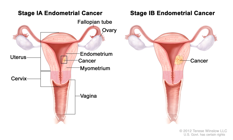 Stage IA and stage IB endometrial cancer shown in two cross-section drawings of the uterus and cervix. Drawing on the left shows stage IA, with cancer in the endometrium and myometrium of the uterus. Drawing on the right shows stage IB, with cancer more than halfway through the myometrium. Also shown are the fallopian tubes, ovaries, and vagina