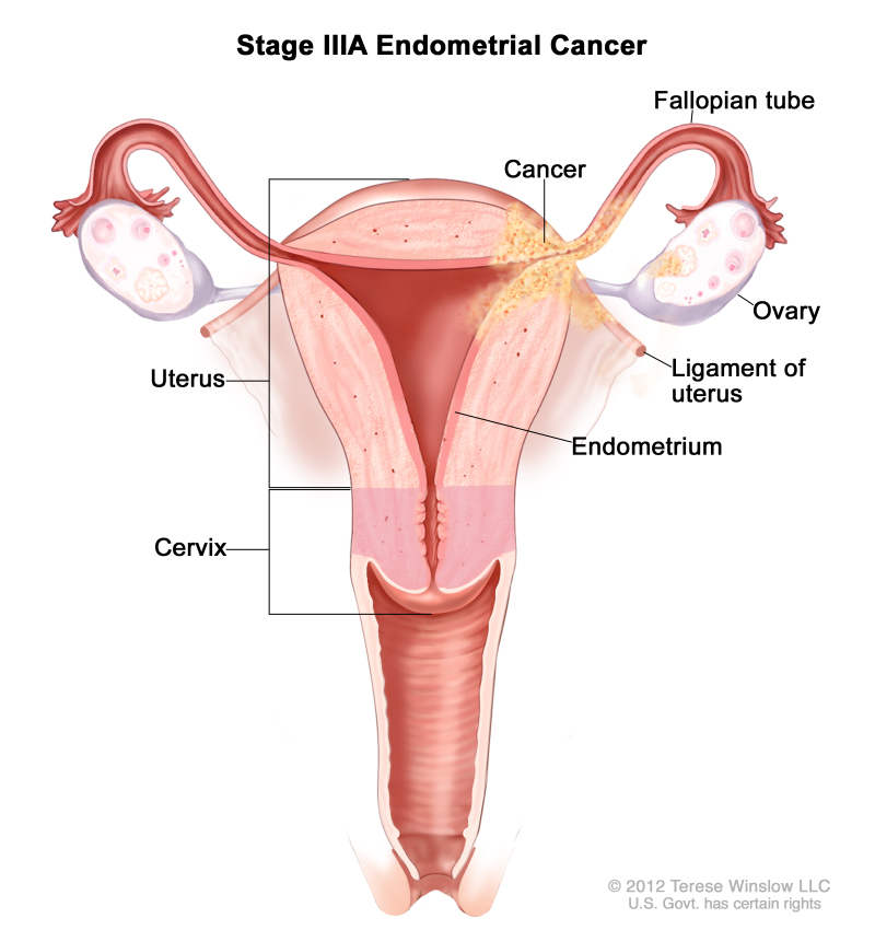 Stage IIIA endometrial cancer shown in a cross-section drawing of the uterus, ligaments of the uterus, cervix, fallopian tubes, ovaries, and vagina. Cancer is shown in the endometrium of the uterus, the outer layer of the uterus, a fallopian tube, an ovary, and a ligament of the uterus.