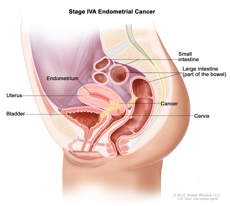 Stage IVA endometrial cancer shown in a side-view cross-section drawing of the uterus, bladder, cervix, vagina, small intestine, and large intestine. Cancer is shown in the bladder, uterus, and bowel.