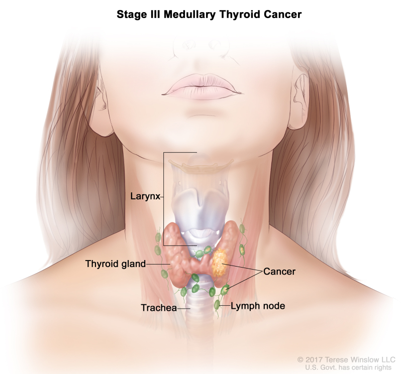 Stage III medullary thyroid cancer; drawing shows cancer in the thyroid gland and in nearby lymph nodes. Also shown are the trachea and larynx