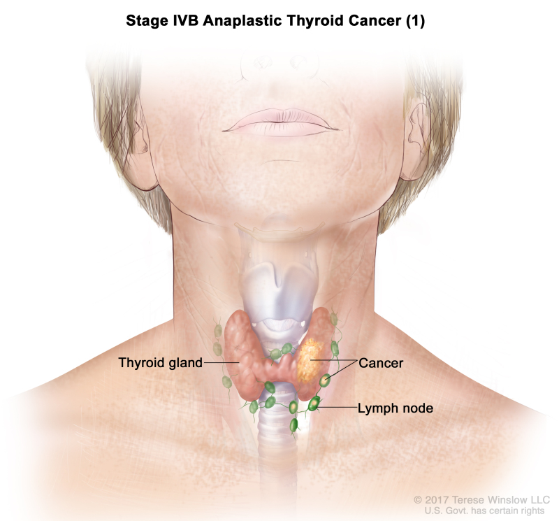 Stage IVB anaplastic thyroid cancer (1); drawing shows cancer in the thyroid gland and nearby lymph nodes.