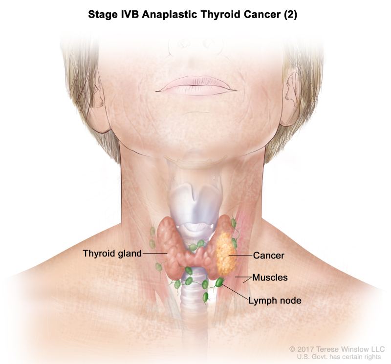 Stage IVB anaplastic thyroid cancer (2); drawing shows cancer in the thyroid gland and nearby muscles in the neck. The lymph nodes are also shown.