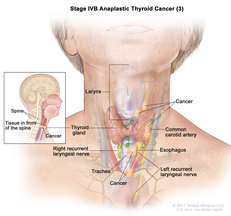 Stage IVB anaplastic thyroid cancer (3); drawing shows cancer in the thyroid gland and in the esophagus, the trachea, the larynx, the left recurrent laryngeal nerve, and the tissue in front of the spine (inset). Cancer has also surrounded the common carotid artery and the blood vessels in the area between the lungs. Also shown is the right recurrent laryngeal nerve.