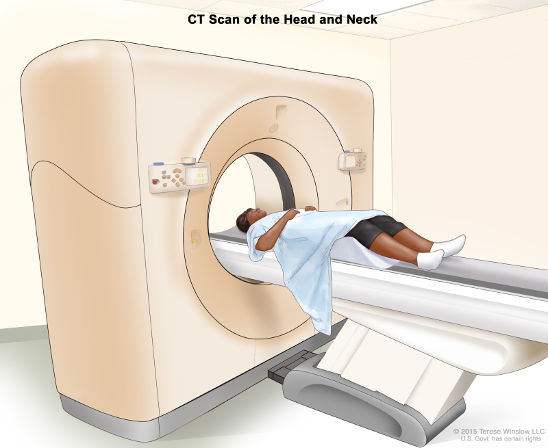 Computed tomography (CT) scan of the head and neck; drawing shows a patient lying on a table that slides through the CT scanner, which takes x-ray pictures of the inside of the head and neck.