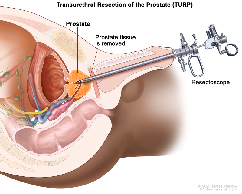 Transurethral resection of the prostate; drawing shows removal of tissue from the prostate using a resectoscope (a thin, lighted tube with a cutting tool at the end) inserted through the urethra.