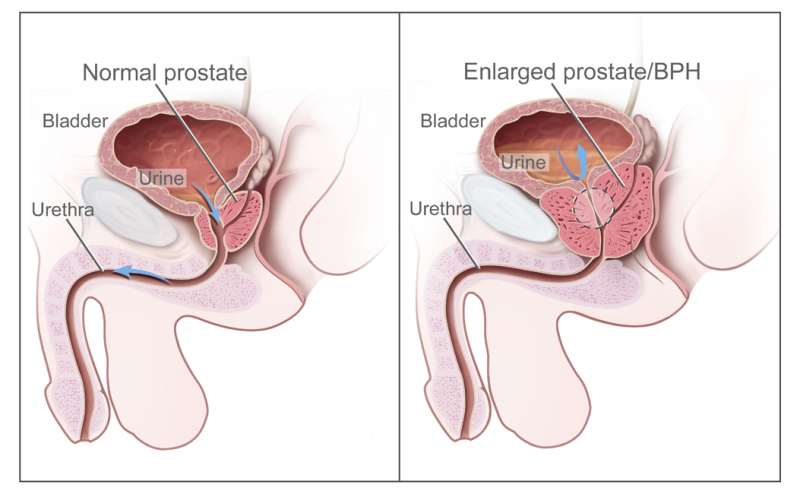 Two-panel drawing shows normal male reproductive and urinary anatomy and benign prostatic hyperplasia (BPH). Panel on the left shows the normal prostate and flow of urine from the bladder through the urethra. Panel on the right shows an enlarged prostate pressing on the bladder and urethra, blocking the flow of urine.