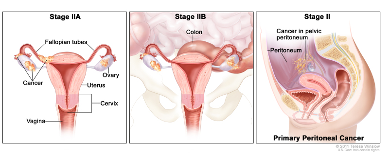 Three-panel drawing of stage IIA, IIB, and stage II primary peritoneal cancer; the first panel (stage IIA) shows cancer inside both ovaries that has spread to the uterus and fallopian tube. The second panel (stage IIB) shows cancer inside both ovaries that has spread to the colon. The third panel (stage II primary peritoneal cancer) shows cancer in the pelvic peritoneum. Also shown are the cervix and vagina.