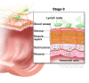 Stage 0 colorectal carcinoma in situ