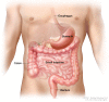 Gastrointestinal stromal tumors (GISTs) may be found anywhere in or near the gastrointestinal tract